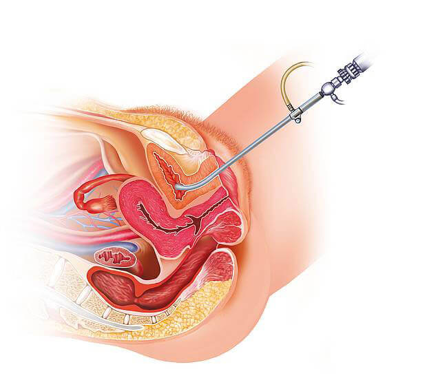 Cistoscopia