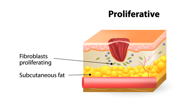 guarigioneferite-fasi-proliferazione