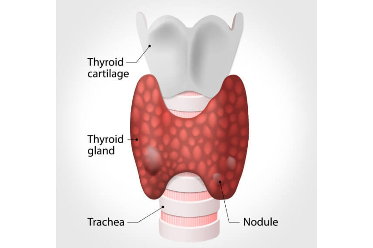 salute-tiroidea-ipertiroidismo-morbo-plummer