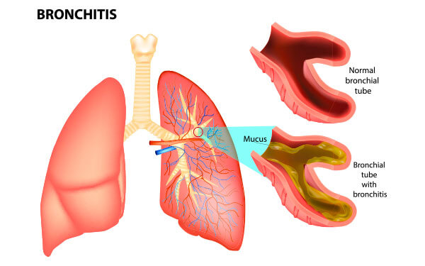 bronchitis