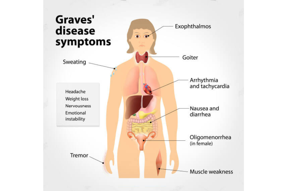 salute-tiroidea-ipertiroidismo-morbo-graves-basedow
