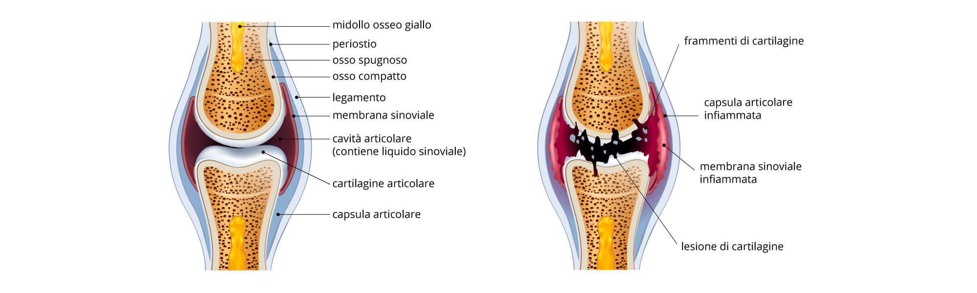 artrosi-patologia-processo-degenerazione_IT