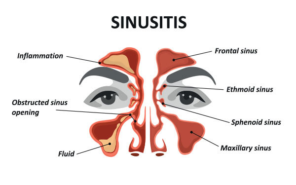 sinusitis