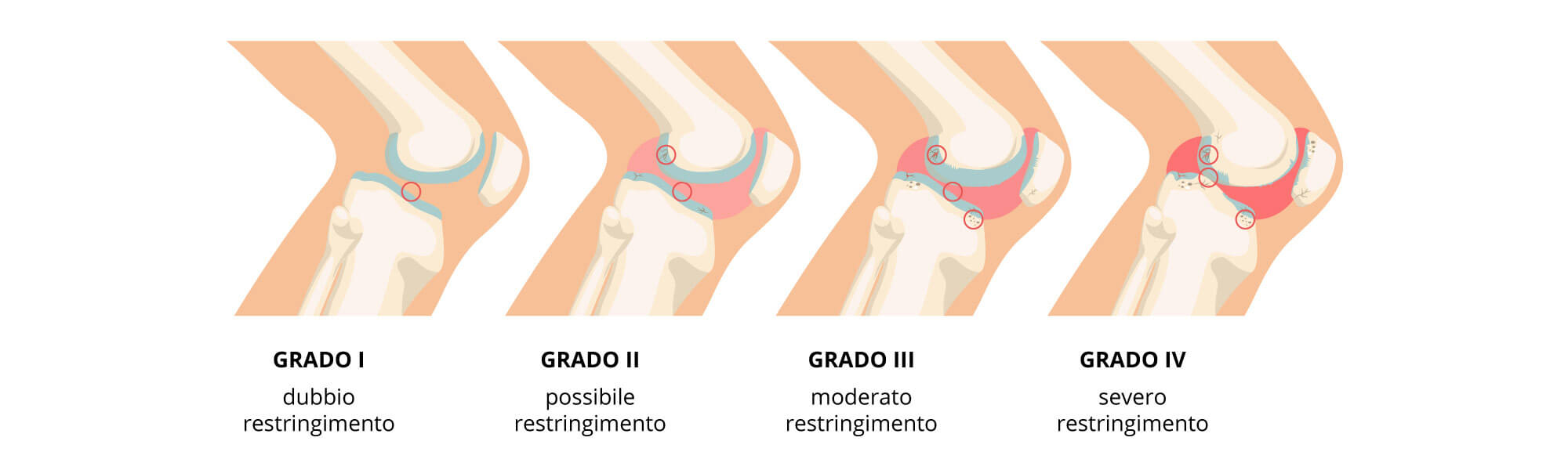 artrosi-patologia-processo-inizio_IT