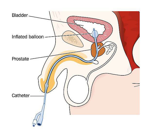salute-urologica-cateterizzazione
