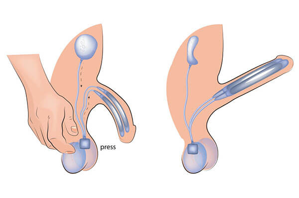 protesi-protheses-prothesen