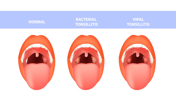 tonsillitis