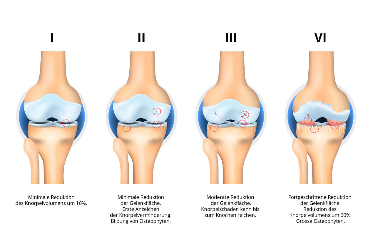 artrosi-patologia-diagnosi-artrosi-ginocchio_DE