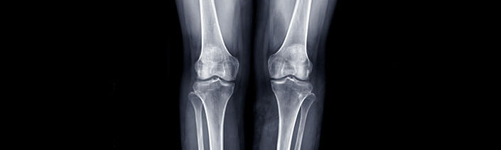 artrosi-patologia-diagnosi-home