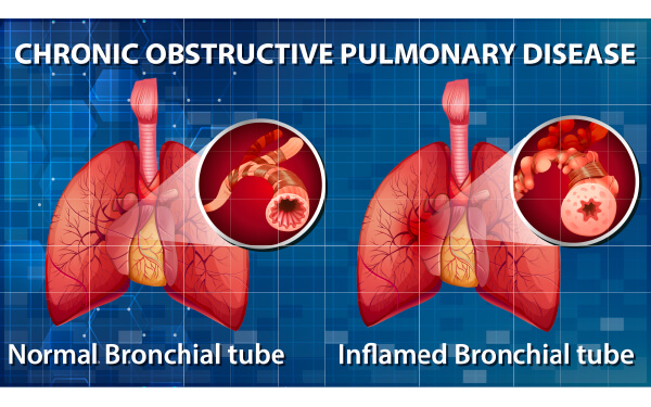 pulmonary-disease