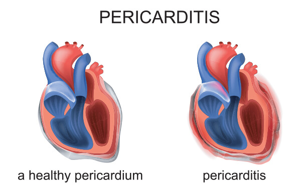 pericardite