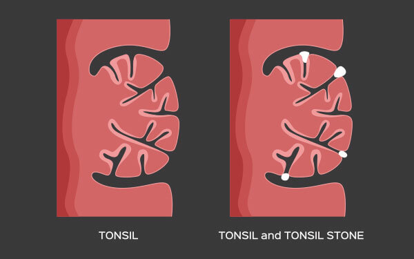 tonsil-stone