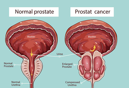 prostata-prostate-prostata-cause