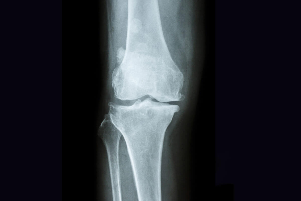 artrosi-patologia-diagnosi-gonartrosi