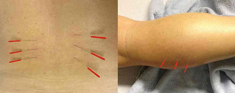 dryneedling