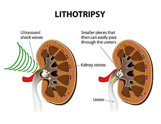 litotrissia