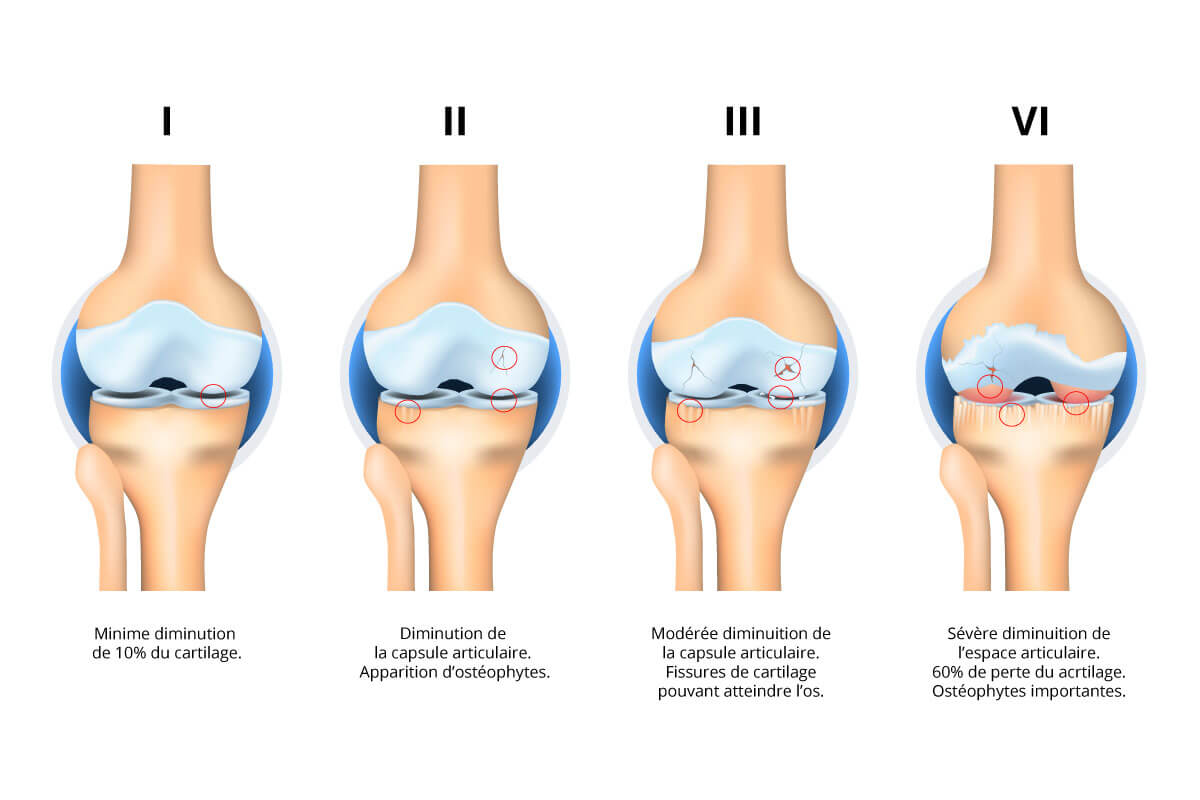 artrosi-patologia-diagnosi-artrosi-ginocchio_FR