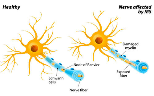 sclerosi-sclerose-sklerose-cause