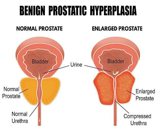 ingrossamento_prostatico