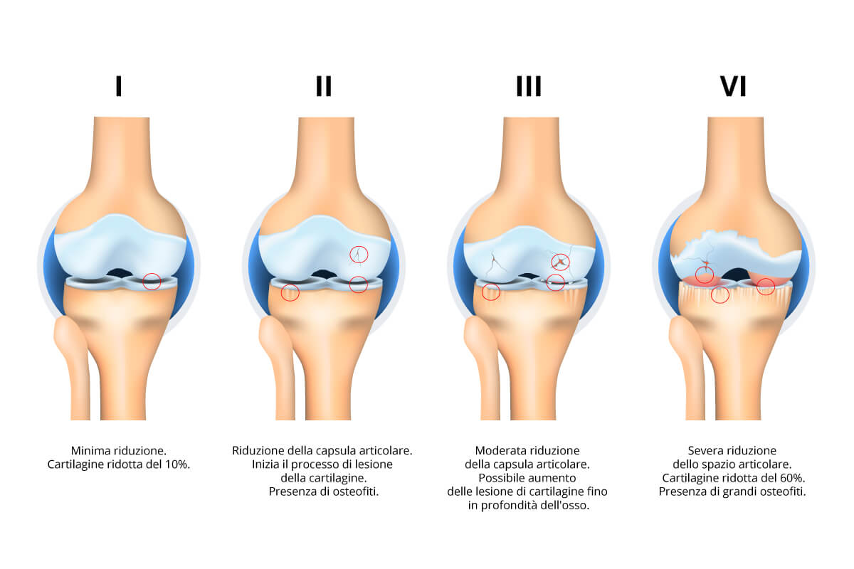 artrosi-patologia-diagnosi-artrosi-ginocchio_IT