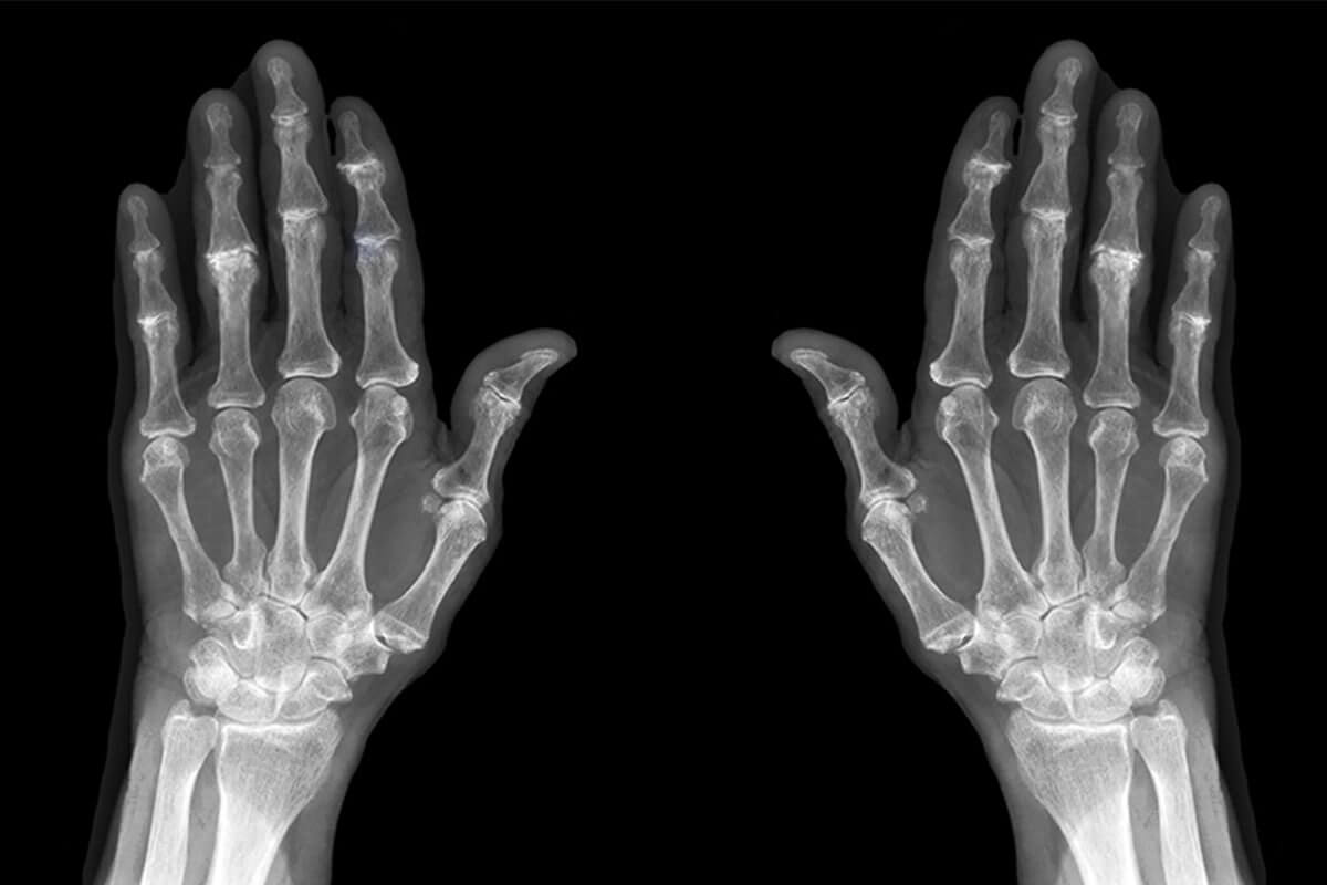 artrosi-patologia-diagnosi-artrosi_mani